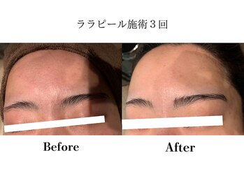 フレイヤ(FREYA)/ララピールBefore→After