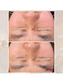 プルーム 久留米店(plume)/ハーブピーリング