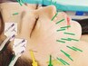 【2回クーポン☆】美容鍼×EMS《２回ご来店いただけます》65分/24000→19000