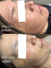 ワンネス(One’Ness)/ハーブピーリング