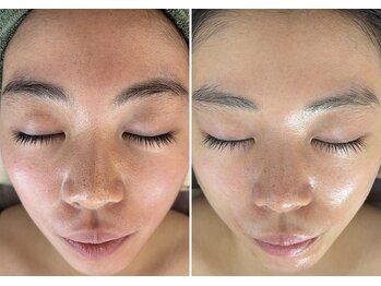 美時雨の写真/毛穴洗浄後ピーリング剤で毛穴の黒ずみやお肌のざらつきを改善!毛穴とお肌を同時に綺麗にしていきます♪