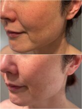 ハチ(Hachi)/ほうれい線が薄くなる理由