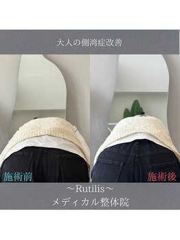 ルチルス(Rutilis)/歪み/肌質改善/リンパ