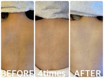 ハーブピーリング 恵比寿/毛孔性 苔癬