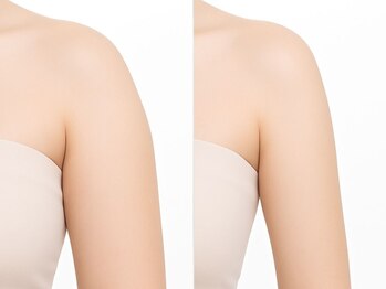 オリエンタルローザ 表参道(Oriental Rosa)の写真/お悩み部位徹底燃焼！エステ版オンダプロ《blancheマイクロ波 NEOWAVES》ならライン崩れも即時に引締め☆