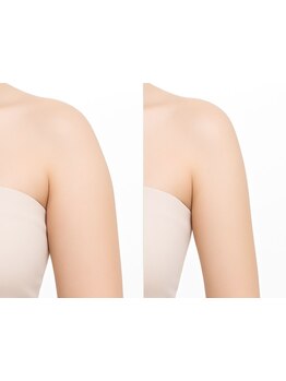 二の腕・ハミ肉ケアをしたい