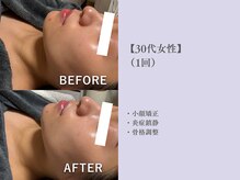 ベルペール(Belle perle)/【小顔】印象リフトフェイシャル