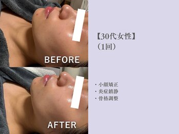 ベルペール(Belle perle)/【小顔】印象リフトフェイシャル