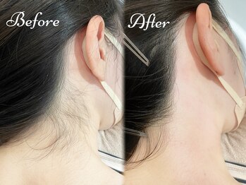 ピミル(PIMIL)/うなじ脱毛