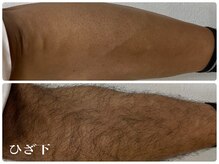 ロシェル(Rochell)/【ひざ下脱毛　男性】