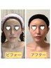 【激変！！】確実小顔！顎引締め輪郭三点小顔調整＋インディバ¥18000