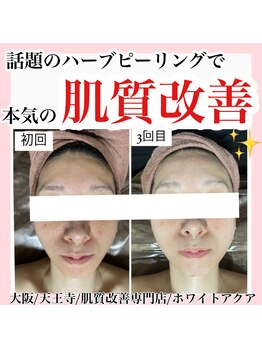 ホワイトアクア 天王寺本店(WHITE AQUA)/ハーブピーリング/大阪/天王寺