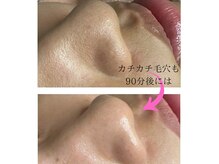 水素で毛穴吸引からパックまで♪とれた汚れは見てもらえます♪