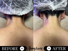 アングレイス(Anngrace)/【全身脱毛うなじ】Before/After