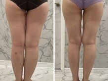 ビノスビューティー(vinos.beauty)/症例写真　下半身痩身1回
