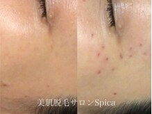 スピカ(SPICA)/目元のシミケア可能！