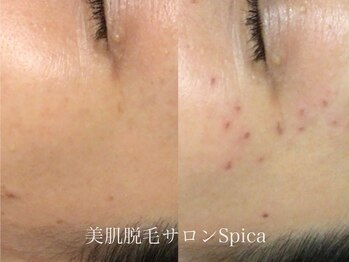 スピカ(SPICA)/目元のシミケア可能!