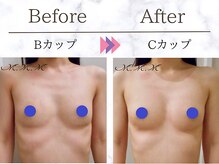 メディカルサロン エム エム エム 銀座プレミアムサロン(M.M.M.)/【バストアップ例】 B→Cカップ