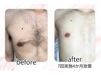 イチキュービー 仙台駅前東口店(19B)/胸毛脱毛の経過