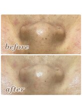 リナル 祐天寺店/毛穴洗浄+小顔エステ付き♪