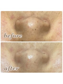 リナル 祐天寺店/毛穴洗浄+小顔エステ付き♪