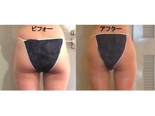 痩身 セル脂肪専門 スタイルデザイン/二の尻（にのじり）★