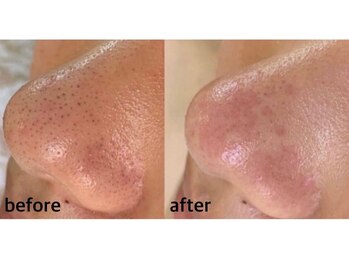 毛穴専科/毛穴洗浄◇ 学割u24あり