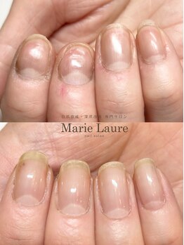 マリーロール 淀屋橋本店(Marie Laure)/自爪育成/深爪矯正/ネイルケア