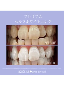 フィールグルック(Viel Gluck)/プレミアムセルフホワイトニング