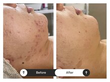 リジュ(Reje)/赤み&フェイスラインニキビケア