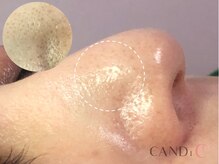 キャンディ 難波心斎橋店(CANDi)/ハイドラピーリング/黒ずみ毛穴