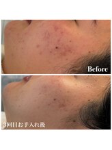 ピュア 川越店/ニキビ徹底ケアコース