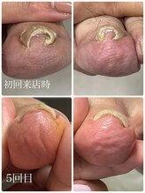 爪屋/4回目の施術後