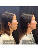 プライミー(PRIMY)/顎周りの大変化