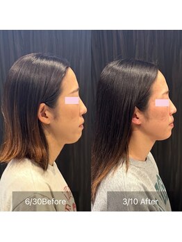 プライミー(PRIMY)/顎周りの大変化