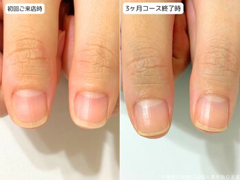 カピリナ(Ka Pilina)/自爪育成・深爪・川崎