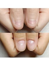 マニエネイル(mani e nail)/深爪矯正/3ヶ月の美爪育成/ケア