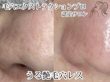 ヴィヴレル(Vivrel)/【毛穴エクストラクションプロ】