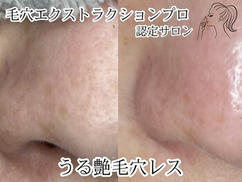 ヴィヴレル(Vivrel)/【毛穴エクストラクションプロ】