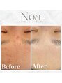 ノア 新宿(Noa) ニキビ 改善