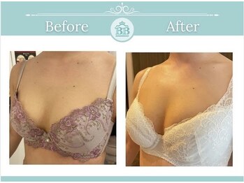 美人バスト 岡山店/【バストアップ症例】★