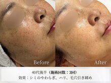 アストリエ グレース 相模大野(Astorie Grace)の雰囲気（次世代型シミシワケアピーリング。相模大野エステ/町田）