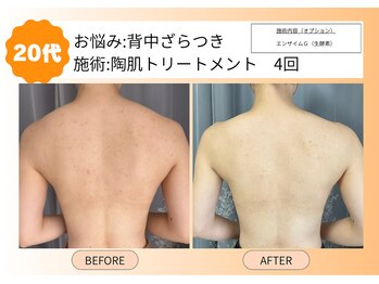 ムーンサン(Moon sun)/背中には断然陶肌トリートメント