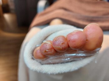 爪切り屋 足楽/血行不良