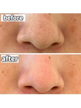 ホワイト ターコイズ/毛穴詰まりは当サロンにお任せ