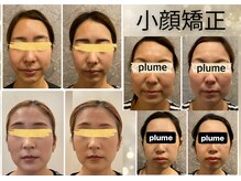 プルーム 久留米店(plume)/小顔矯正