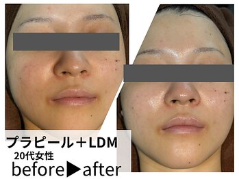 サロンスペース/20代女性【プラピール+LDM】