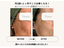 プルーム(Plume)/6ヶ月の肌育成結果（シミケア）