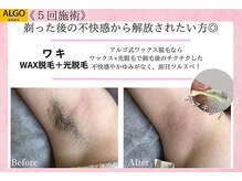 アルゴ 豊中岡町駅前店(ALGO)/【アルゴ式WAX脱毛+光脱毛】