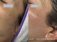 レオン(Leon)/ビフォーアフター